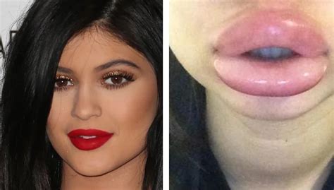 Disturbing Trend Leaving Teens With Bruised Swollen Lips Wish Tv