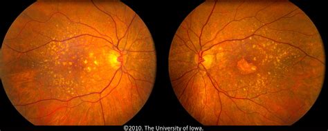 Age Related Macular Degeneration Progression From Atrophic To