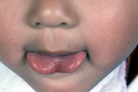 Tongue Tie Information For Parents And Practitioners Tongue Tie
