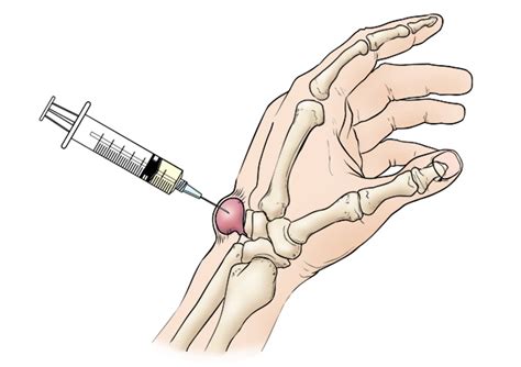 Ganglion Cyst Of The Wrist And Hand Orthoinfo Aaos Porn Sex Picture