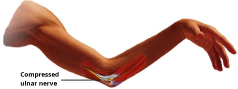 Cubital Tunnel Syndrome The Nerve Surgery Centre