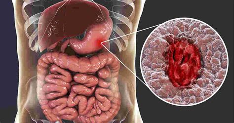 Stomach Ulcers Causes Types Symptoms And Treatment