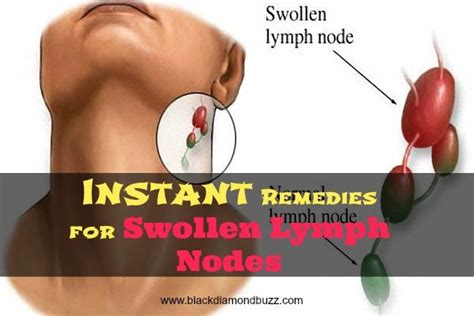 Discover Here Instant Remedies For Swollen Lymph Nodes And How To