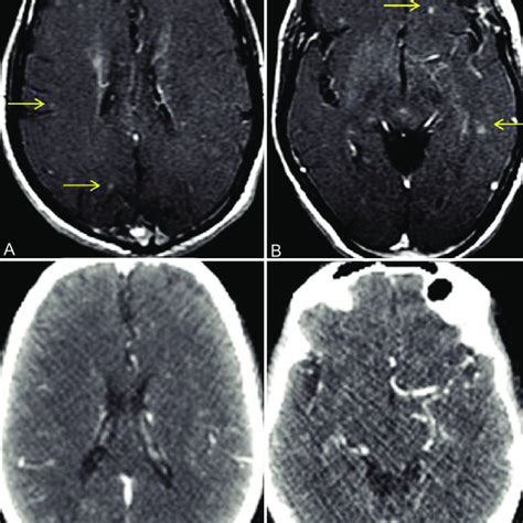 A D Brain Metastases In Asymptomatic Patient Ct Scan Versus Mri