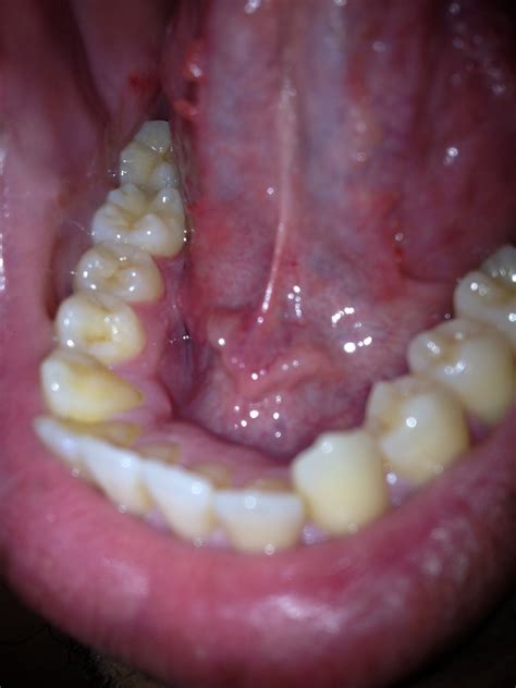 Hithis Morning I Noticed Some Growths Underneath My Tongue