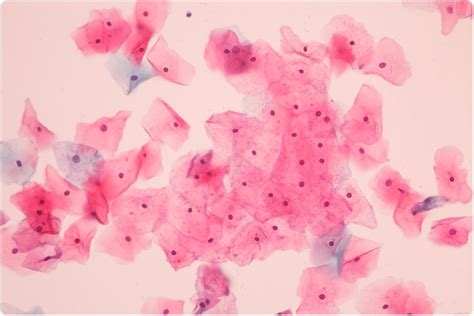 Detecting cervical cancer early with a pap smear gives you a greater chance at a cure. New test shown to be 100% effective at detecting cervical ...