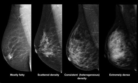 Prenatal Diethylstilbestrol Exposure And Mammographic Density