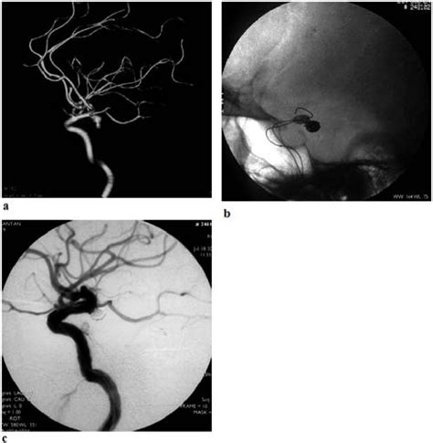 Figure From Endovascular Treatment Of Cerebral Aneurysms During Acute