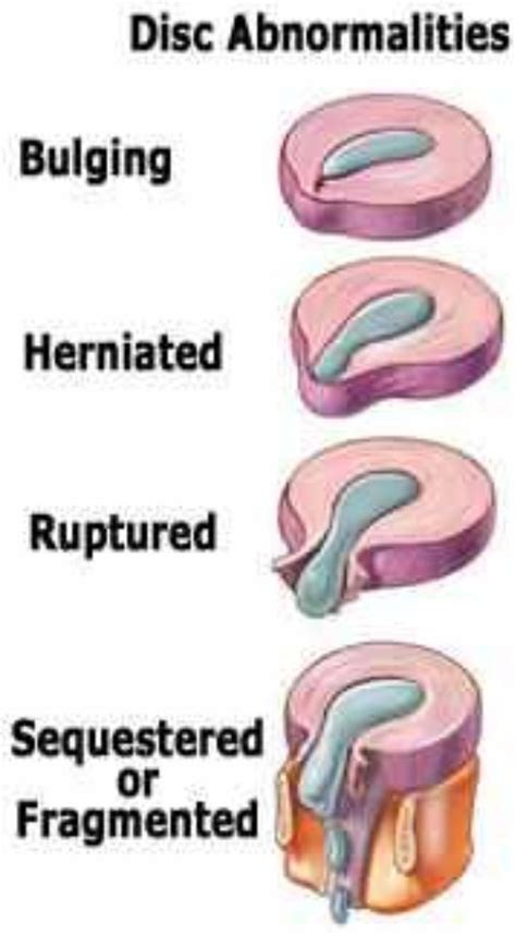 A bulging disc develops when a vertebral disc bulges into the spinal canal, sometimes compressing a nerve in the process. Pin on Herniated Discs- I know this pain all to well.