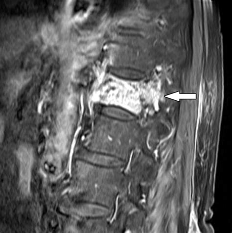 Osteoporotic Vertebral Compression Fracture Image