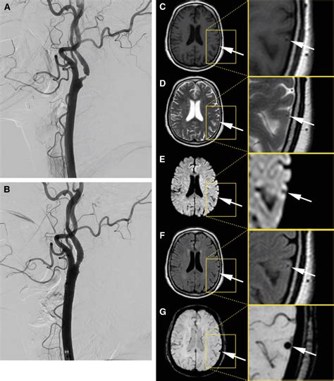 Figure 1 From A Case Of Suspected Metallic Embolism After Carotid