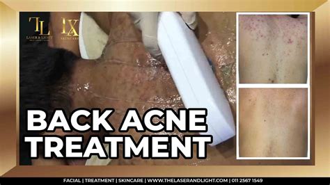 Back Acne Treatment⚡️get Rid Bacne Using Medical Grade Devices Youtube