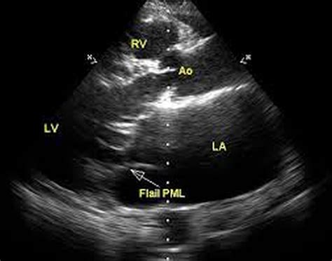 Flail Posterior Mitral Leaflet With Mitral Regurgitation All About Cardiovascular System And