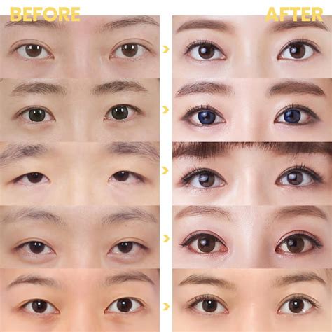 Double Eyelid Surgery In Korea For Bigger Well Defined Eyes Meimekorea