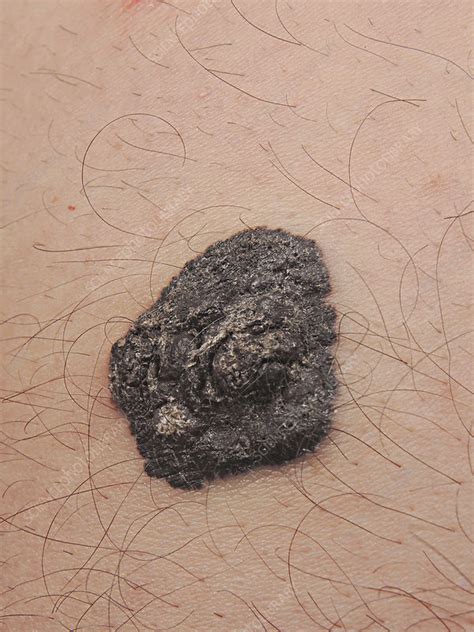 Melanoma Of The Thigh Stock Image C0507397 Science Photo Library
