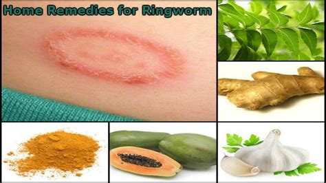 Home Remedies For Ringworm Daad Ki Samasya Se Duri Paye