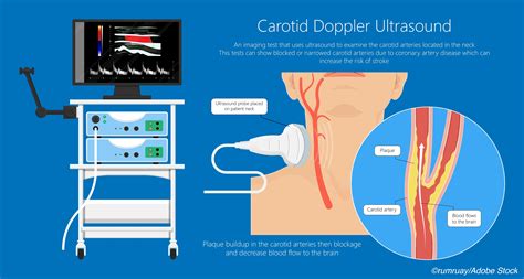 Uspstf Still Nixes Mass Screening For Carotid Artery Stenosis Bipmd