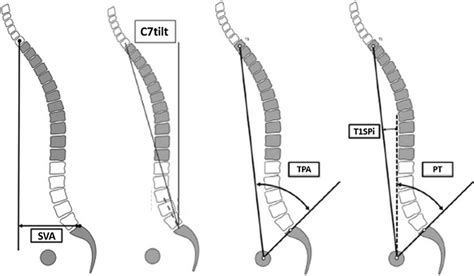 Global Spinal Sagittal Alignment Parameters Sva C7 Tilt Tpa T1spi