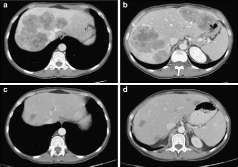 Conversion Chemotherapy For Unresectable Colorectal Liver Metastases