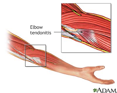 Check out our hands forearm tendon selection for the very best in unique or custom, handmade pieces from our shops. Tendinitis