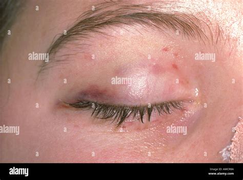 A Photograph Of A Petechial Rash On The Right Eyelid Of A Person Stock