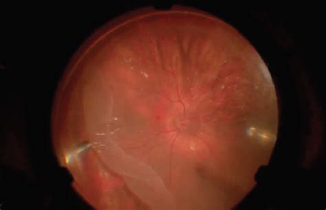 Digitally Assisted Surgery For Retinal Detachment With Giant Retinal