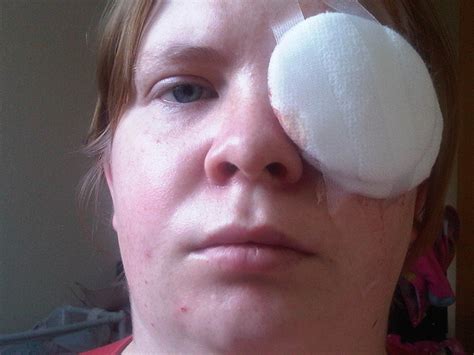 After the surgery, your doctor will give you specific instructions on how to care for you may need to wear an eye shield while sleeping to prevent damage that could be caused by lying on recovery from retinal detachment surgery is a long, slow process. Retinal Detachment - My Story: DAY 1 - AFTER surgery ...
