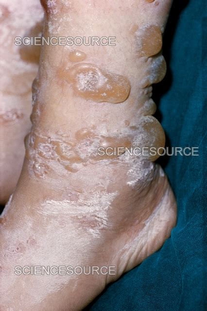 Bullous Erythema Multiforme Stock Image Science Source Images