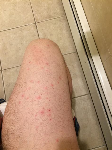 My Upper Leg Has Red Dots Along It I Want Them Gone Anyone Have