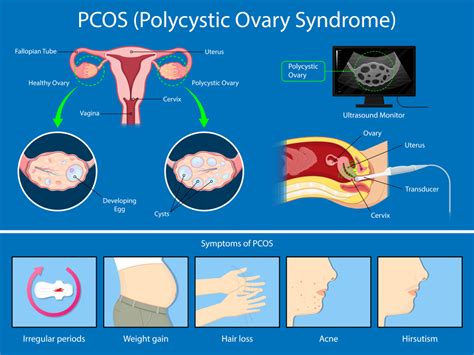 Pcos And Infertility Causes Effects On Fertility And Complications