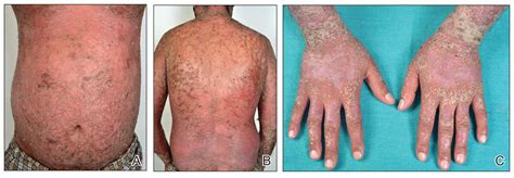 Sudden Cardiac Death In A Young Patient With Psoriasis Mdedge Dermatology