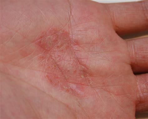 Mild Eczema On Hand Pictures Photos