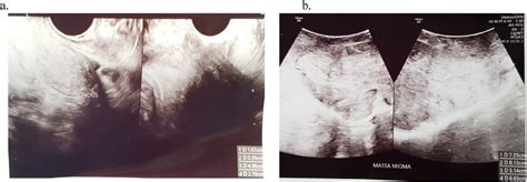 First Case Ultrasound Evaluation Revealed Normal Retroflexed Uterine