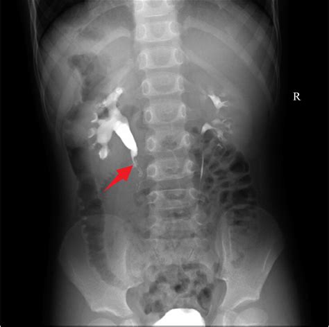 Hydronephrosis Ivp