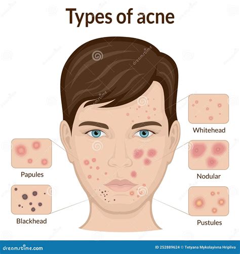 Types Of Acne Stock Vector Illustration Of Efflorescence 252889624