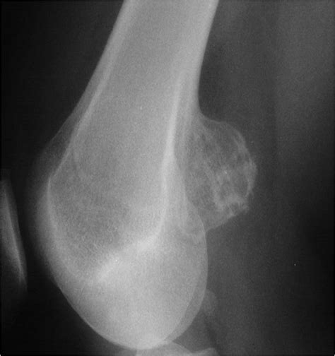 Osteochondroma Benign Bone Tumor Tumors Of The Bone