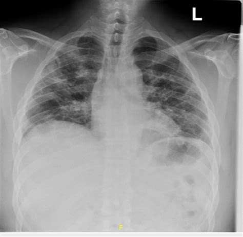 A Chest X Ray Was Taken One Month After Hospitalization Without