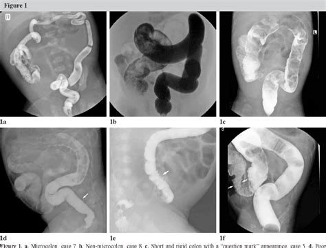 Pdf Total Colonic Aganglionosis Reappraisal Of Contrast Enema Study