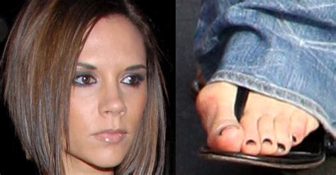 Celebrities With Bunions New Health Advisor