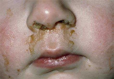 Rhinitis Mucus And Pus Discharge From Childs Nose Stock Image M130