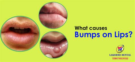 Bump On Lips Swollen Bump On Lip