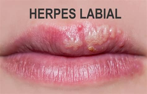 Diferença De Herpes Labial E Afta Jkl Odontologiajkl Odontologia