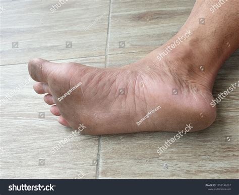 Itchy Lower Leg Causes Treatment Stock Photo 1752146267 Shutterstock