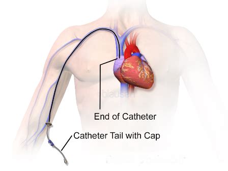 Peripherally Inserted Central Catheter PICC Line Insertion Mercy