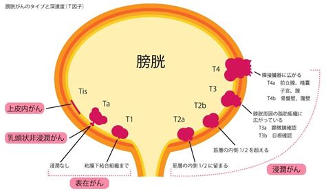 クライブは膀胱が小さ, 膀胱はそのままだわ, 膀胱に対するものがあります, 俺の膀胱はポット並みのサイズだ, つまり膀胱結石を除去しているところですが. 癌 ステージ 膀胱