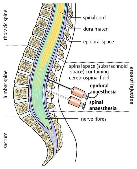Difference Between Epidural And Spinal Injections Epidural
