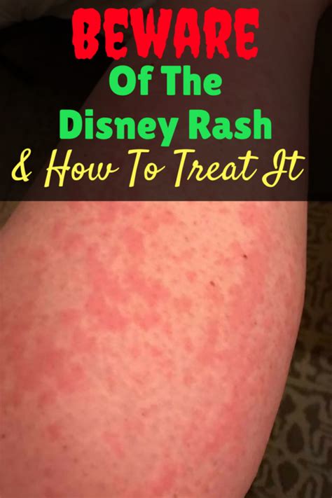 Beware Of The Disney Rash And How To Treat