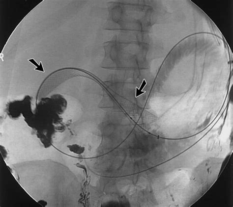 Gastroduodenal Stent Placement Current Status Radiographics