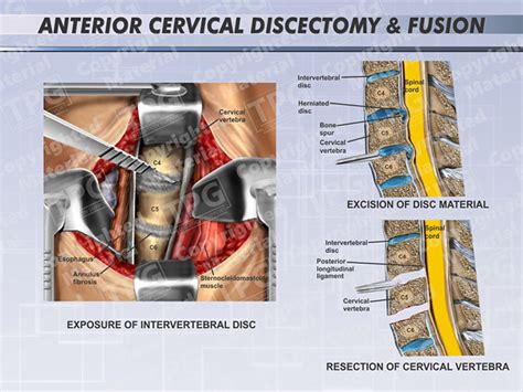 Anterior Cervical Discectomy Fusion Order