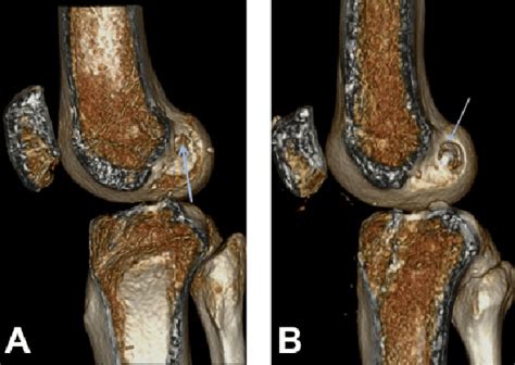 A The Graft Tunnel Aperture In Reconstruction With A Hamstring Graft